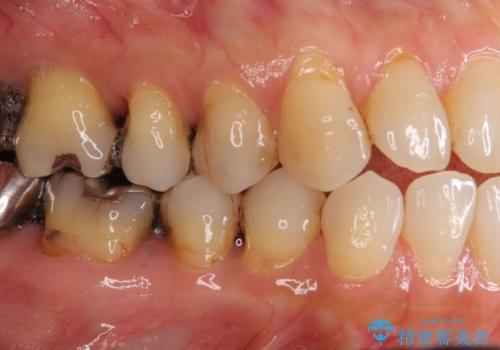 歯根が露出している歯の歯肉再生　根面被覆術の治療前