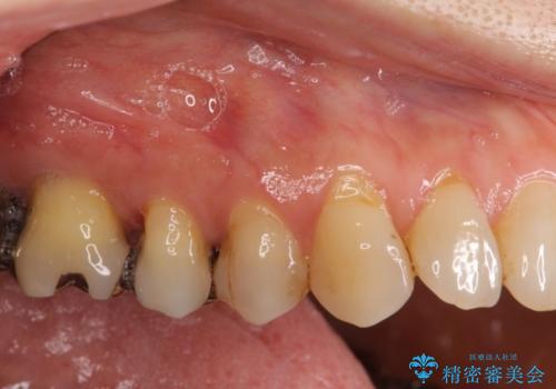 歯根が露出している歯の歯肉再生　根面被覆術の治療前