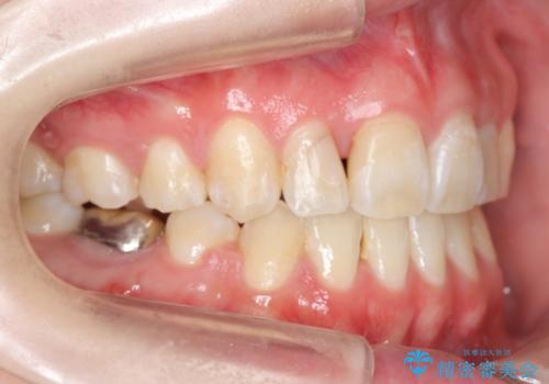 20代女性　前歯のがたがた　後ろに引っ込んでいる歯があるの治療後