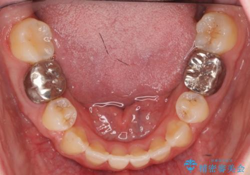 20代女性　前歯のがたがた　後ろに引っ込んでいる歯があるの治療後
