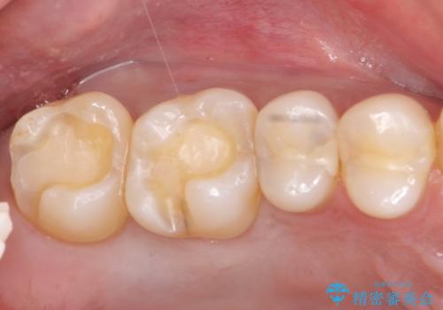 40代男性　銀歯を全て白くしたい　マウスピース矯正も希望の治療中