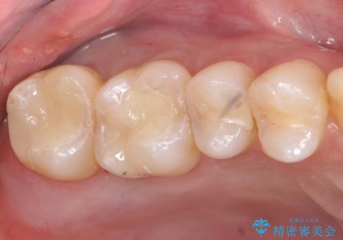 40代男性　銀歯を全て白くしたい　マウスピース矯正も希望の治療後