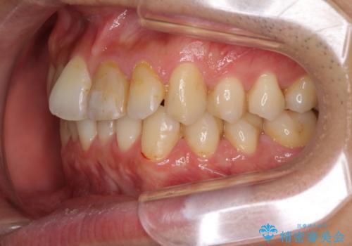 上下前歯のでこぼこをきれいに　インビザラインによる歯列矯正の治療前