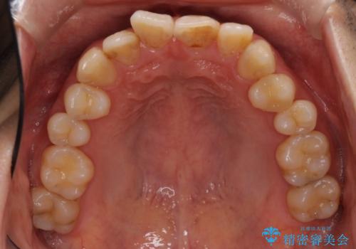 上下前歯のでこぼこをきれいに　インビザラインによる歯列矯正の治療前