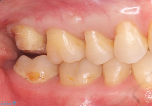 20代男性 上の奥歯のレジン修復下の虫歯　の治療中