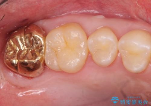 20代男性 上の奥歯のレジン修復下の虫歯　の治療後
