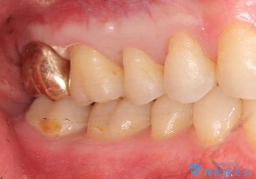 20代男性　上の奥歯のレジン修復下の虫歯　の治療後