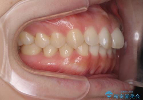 出ている前歯を引っ込めたい　インビザラインによる矯正治療の治療前