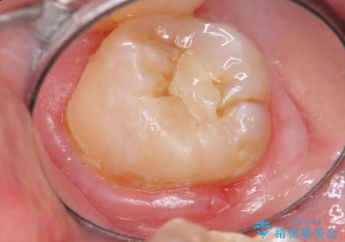 20代男性 上の奥歯のレジン修復下の虫歯　の治療前