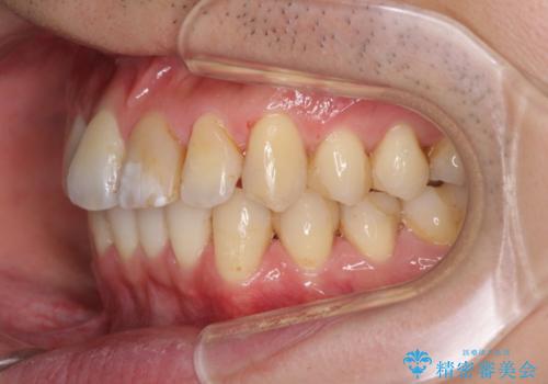 上下前歯のでこぼこをきれいに　インビザラインによる歯列矯正の治療中