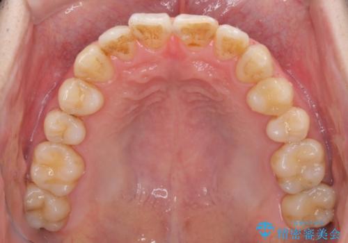 上下前歯のでこぼこをきれいに　インビザラインによる歯列矯正の治療中