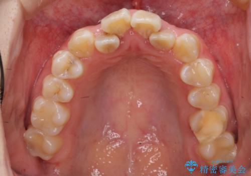 20代女性　前歯のがたがた　後ろに引っ込んでいる歯があるの治療前
