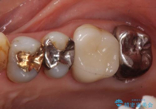 60代女性　銀歯の下が虫歯　隣も虫歯の治療前