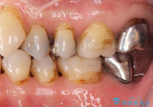 60代女性　銀歯の下が虫歯　隣も虫歯の治療前