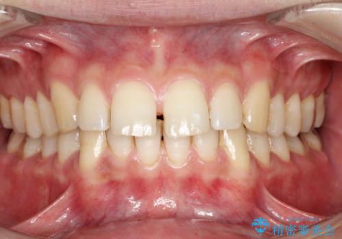 インビザラインによる矯正治療と銀歯の審美治療の治療前