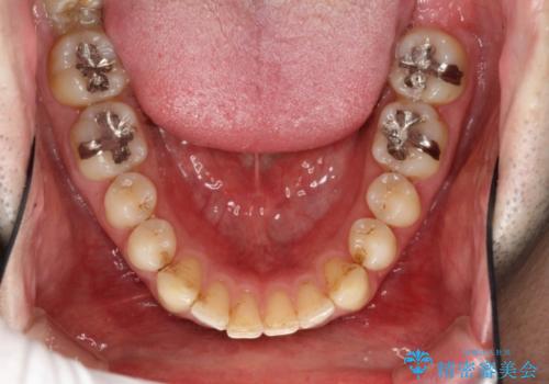 インビザラインによる矯正治療と銀歯の審美治療の治療前