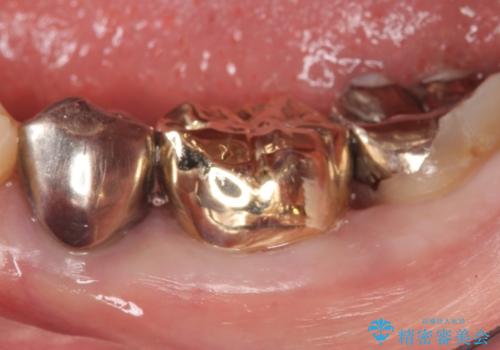 ゴールド(PGA)クラウン　虫歯治療の治療後