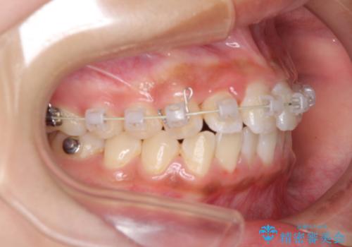ワイヤー矯正とマウスピース矯正を併用して、短期間で歯列矯正の治療中