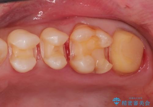 金属→セラミックへのやり直し　予想以上に深い虫歯とその処置の治療中