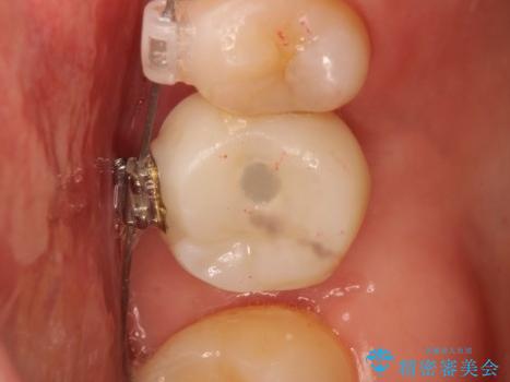 インプラントと部分矯正による奥歯のかみ合わせの改善の治療前