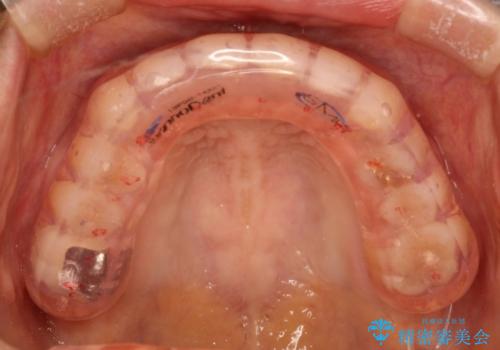 高性能なナイトガードの治療後
