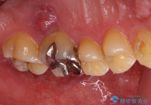 ぷくっと腫れた歯肉が気になる　根管治療とセラミックの症例 治療前