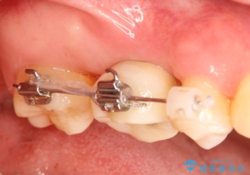 インプラントと部分矯正による奥歯のかみ合わせの改善の治療中