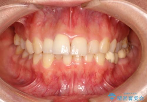 根管治療で変色した歯をセラミックで白くの症例 治療後