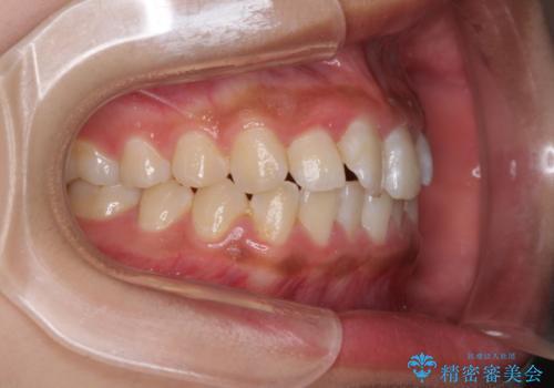 ワイヤー矯正とマウスピース矯正を併用して、短期間で歯列矯正の治療前