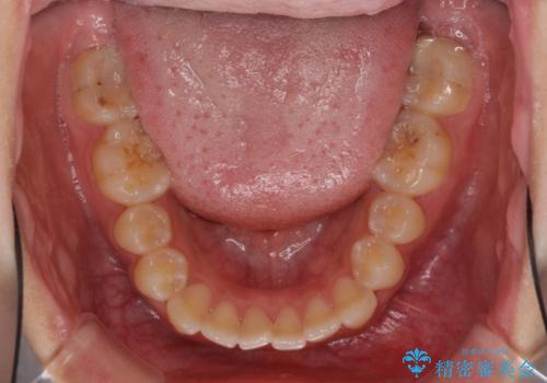 ワイヤー矯正とマウスピース矯正を併用して、短期間で歯列矯正の治療前
