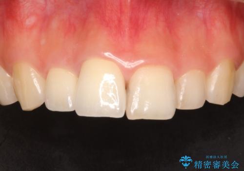 根管治療で変色した歯をセラミックで白くの治療後
