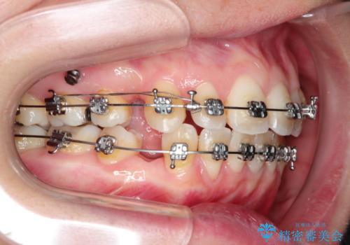 出っ歯を治したい　メタル装置による抜歯矯正の治療中