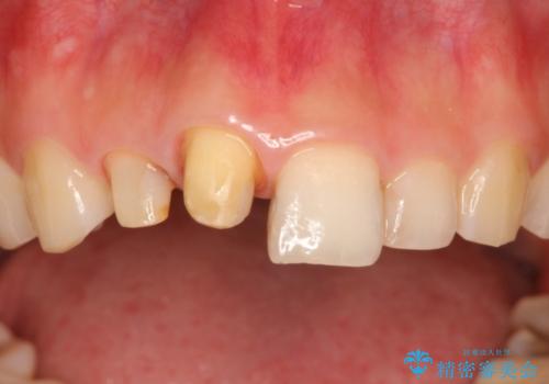 根管治療で変色した歯をセラミックで白くの治療中