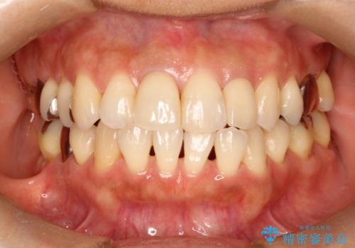 前歯の被せものの治療後