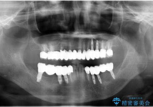 虫歯だらけの口腔内　全顎治療の治療後
