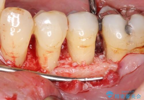 [歯周病治療]  再生療法で歯を残す①