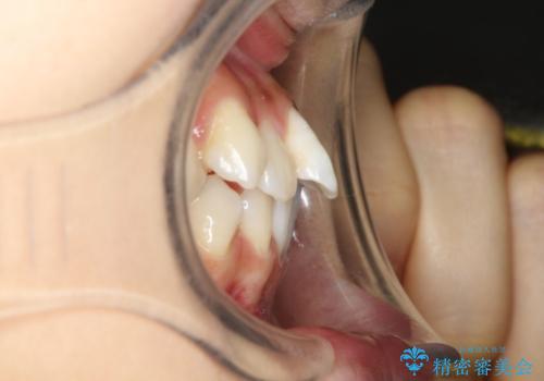 下の前歯が一本少ない　ワイヤーによる出っ歯の矯正治療の治療前