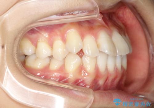 下の前歯が一本少ない　ワイヤーによる出っ歯の矯正治療の治療前