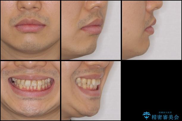 上下前歯のでこぼこをきれいに　インビザラインによる歯列矯正の治療前（顔貌）