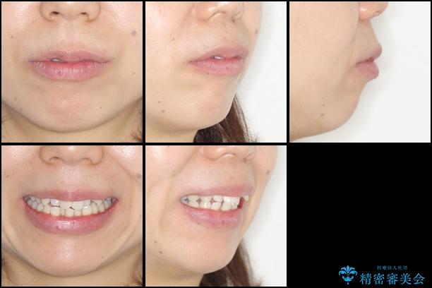 出っ歯を治したい　メタル装置による抜歯矯正の治療前（顔貌）