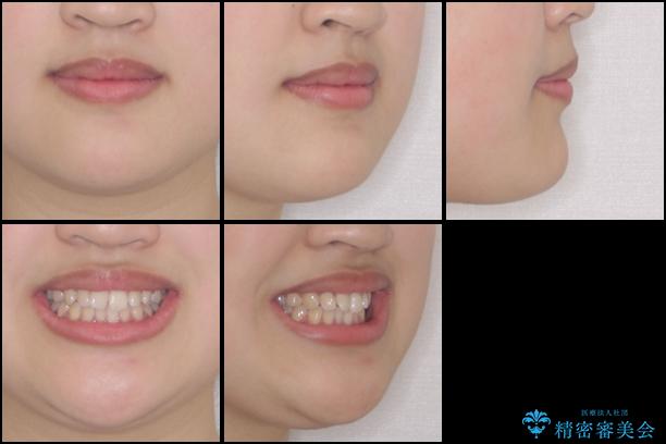 ワイヤー矯正とマウスピース矯正を併用して、短期間で歯列矯正の治療前（顔貌）