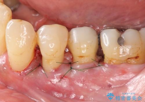 [歯周病治療]  再生療法で歯を残す①の治療中
