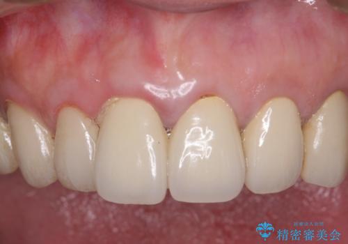 虫歯だらけの口腔内　全顎治療の治療前