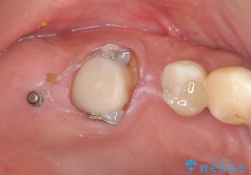 [天然歯の遠心移動]  適切なインプラントー歯牙距離を確保するの治療前