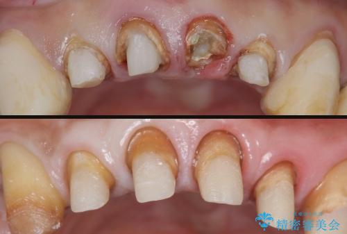 多発した深い虫歯　歯周外科による歯肉改善セラミック補綴