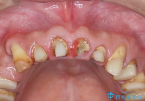 多発した深い虫歯　歯周外科による歯肉改善セラミック補綴の治療中