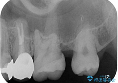 左上奥歯の虫歯　白い詰め物セラミックインレーの治療後