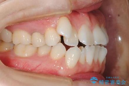 歯を抜かずに八重歯をきれいに!　インビザラインによる全顎矯正治療