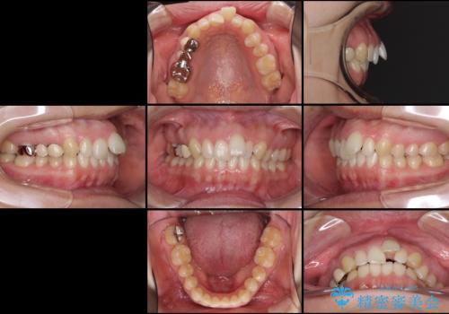 上の前歯の出っ歯を抜歯矯正で改善の治療前