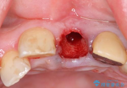 [歯牙破折]  歯槽堤保存術を応用した上顎前歯ブリッジの治療中